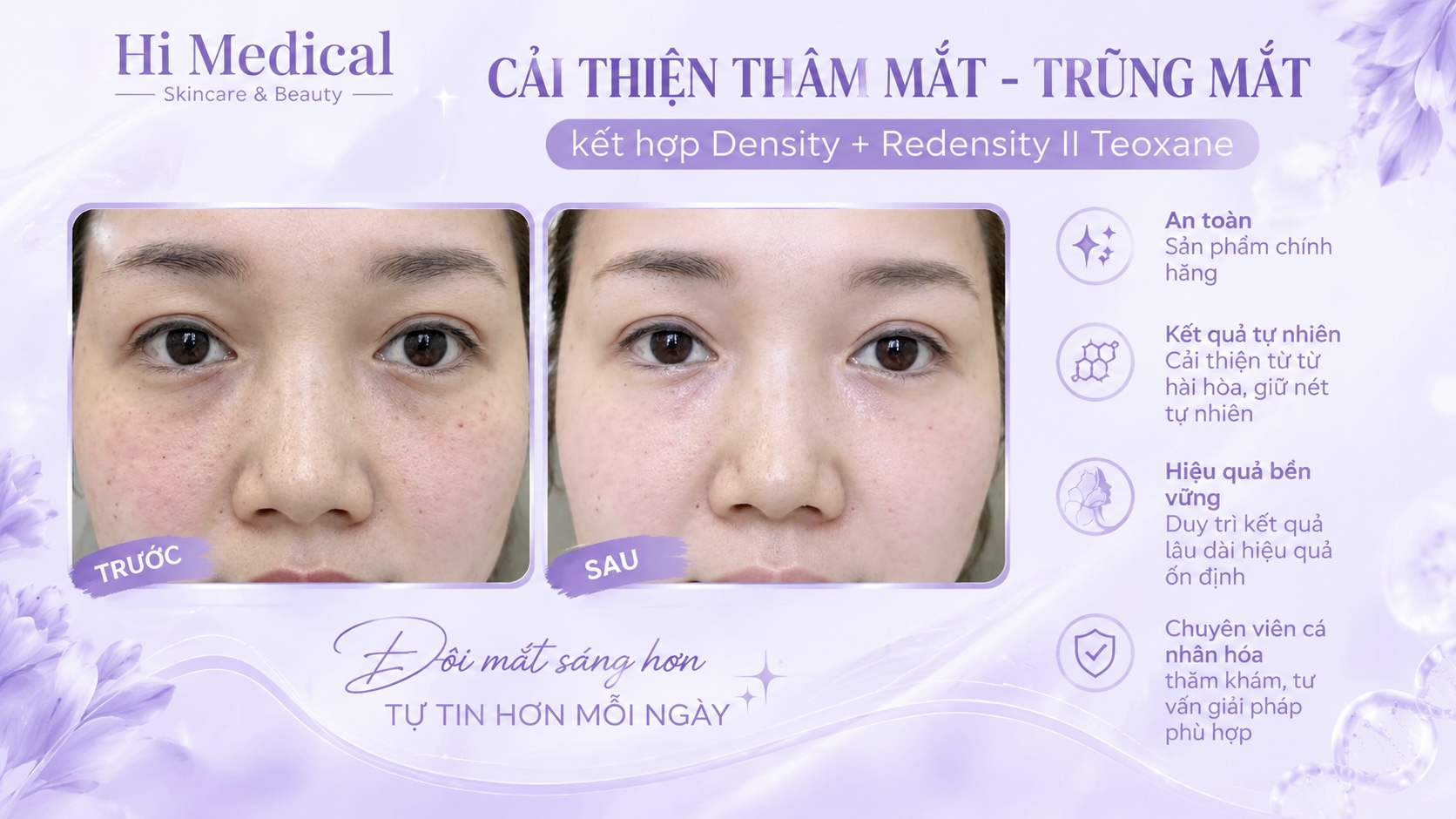 Trị thâm quầng mắt bằng công nghệ IPL: trả lại ánh nhìn tươi trẻ sau 2 liệu trình