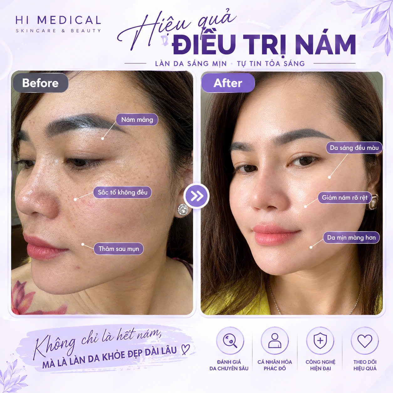 Trị nám ở đâu tốt tại Vũng Tàu? 5 tiêu chí chọn đúng nơi